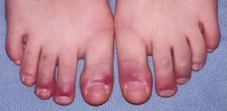 What Is Raynaud’s Syndrome?